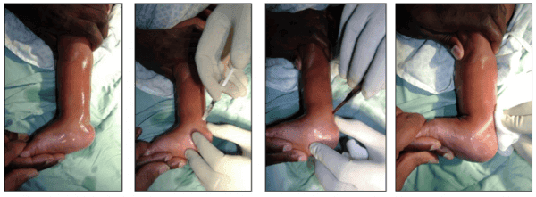 Clubfoot brace