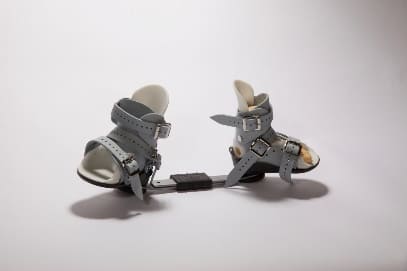 Clubfoot casting