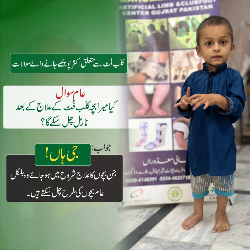 Clubfoot care for children