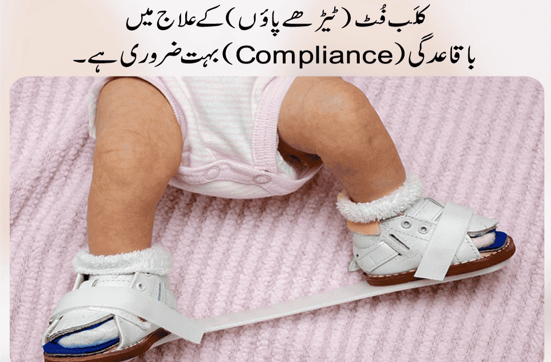 Clubfoot information