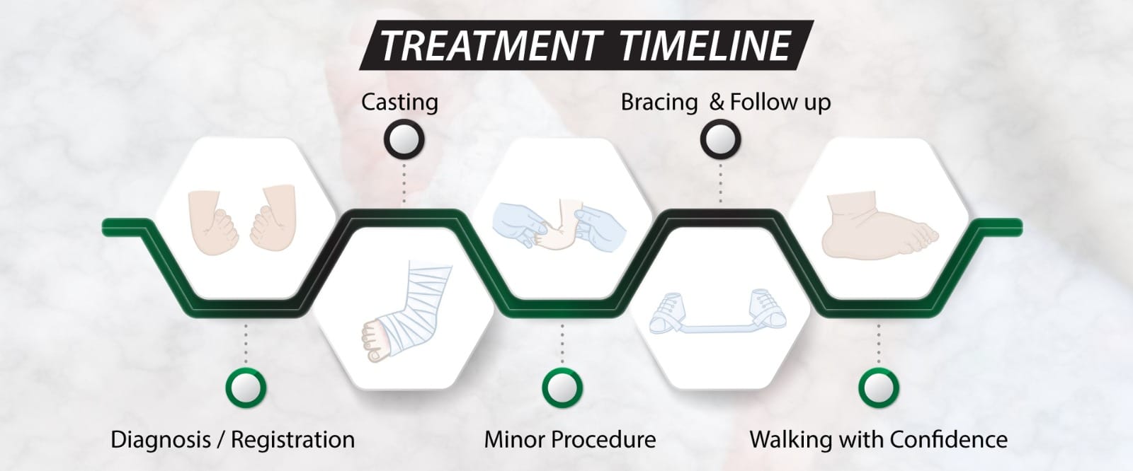 Clubfoot treatment